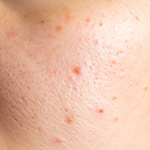 ニキビ・ニキビ跡