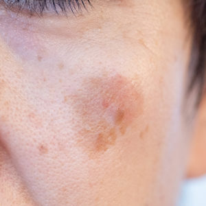 しみ・そばかす・美白