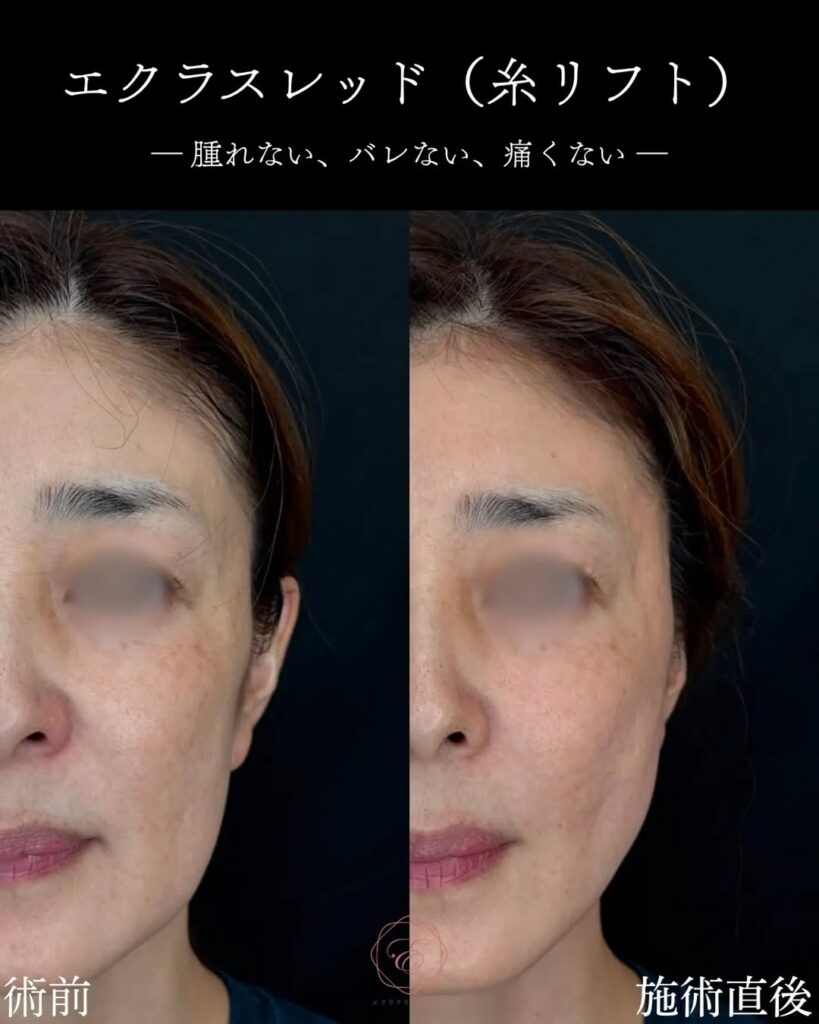 糸リフト 症例写真1