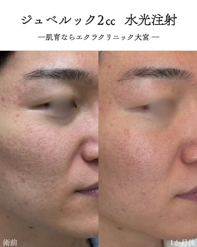 水光注射 ジュベルック2cc 症例写真