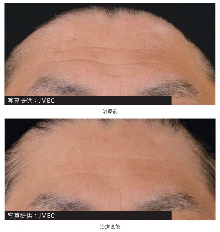 ソフウェーブ（全顔＋首） 症例写真