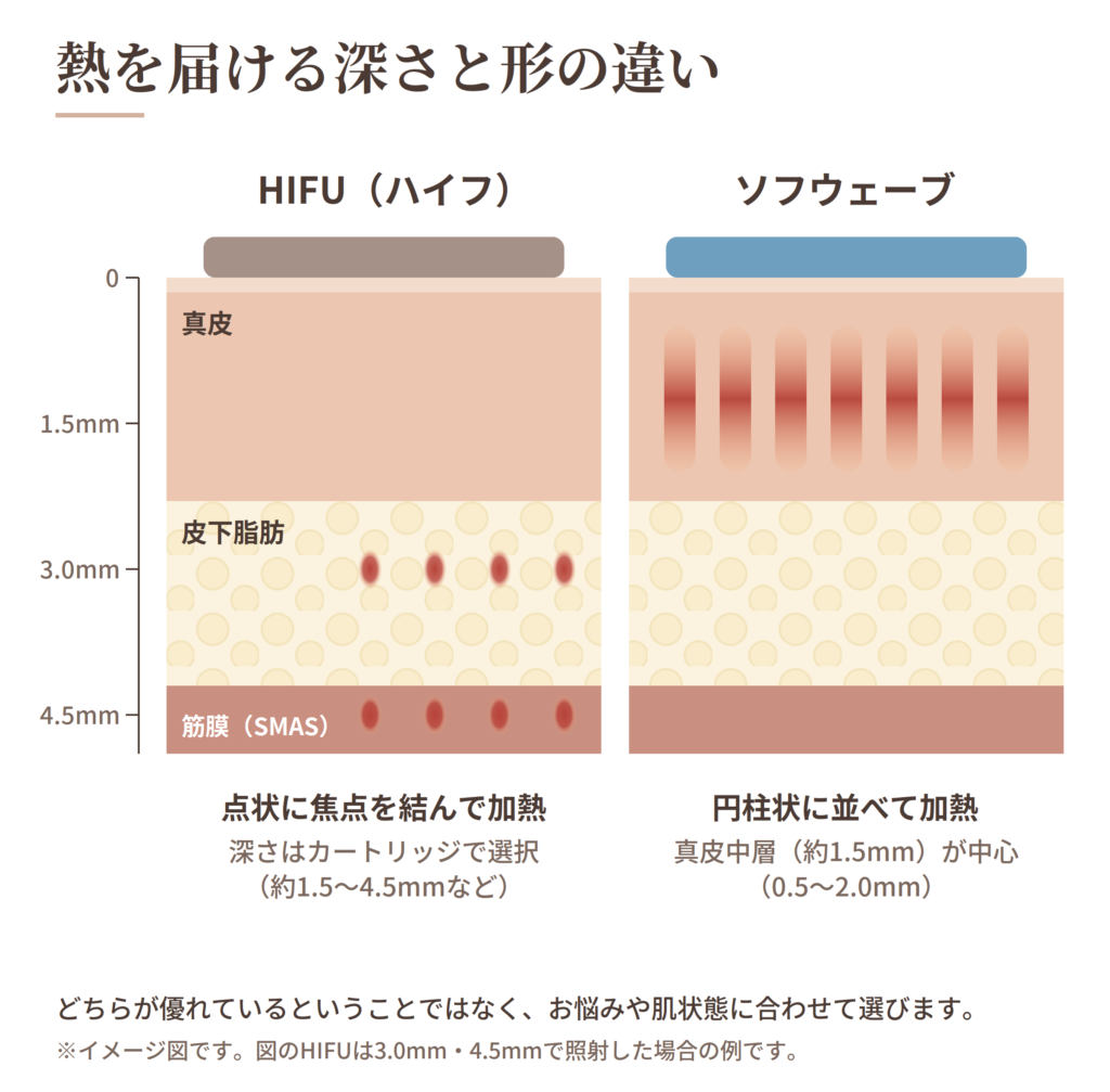 HIFUとソフウェーブの熱を届ける深さと形の違い（イメージ図）